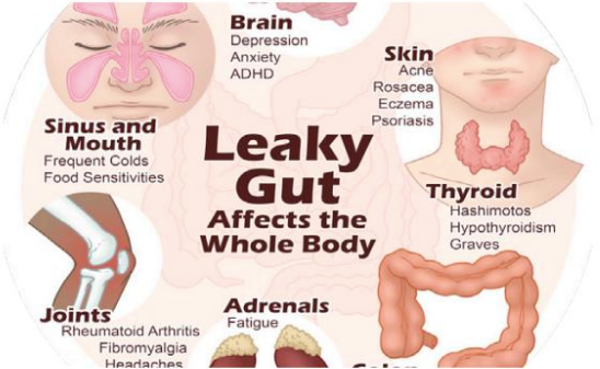 Leaky Gut Syndrome